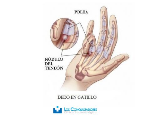 tendosinovitis estenosante